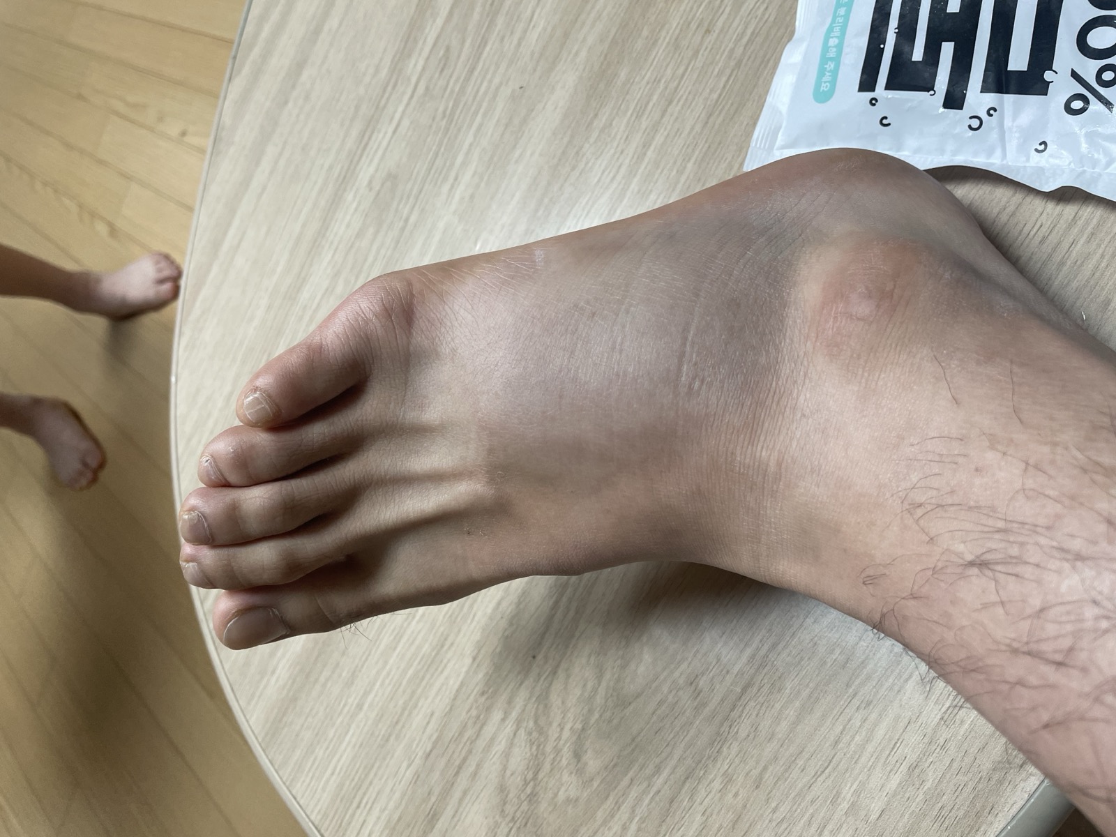 5번 중족골이 부러진 왼발 바깥쪽. 새끼발가락 아래가 부어오르고 시퍼렇게 멍이 올라와 있다